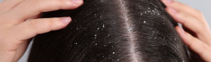 TriKh Hairlife | trattamento intensivo antiforfora